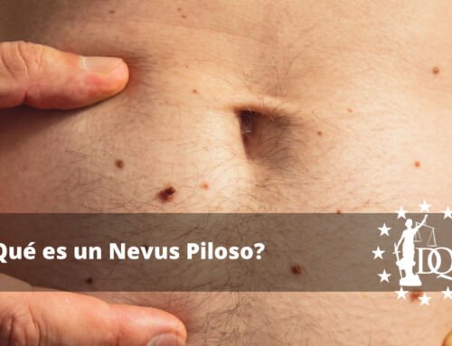 ¿Qué es un Nevus Piloso?