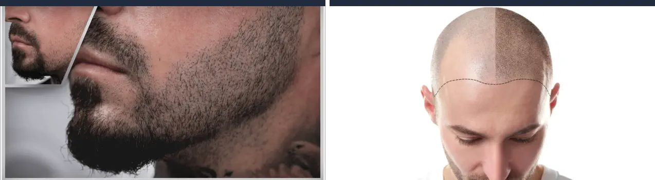 Curso de Micropigmentación - Barba y Cabello en Hombres